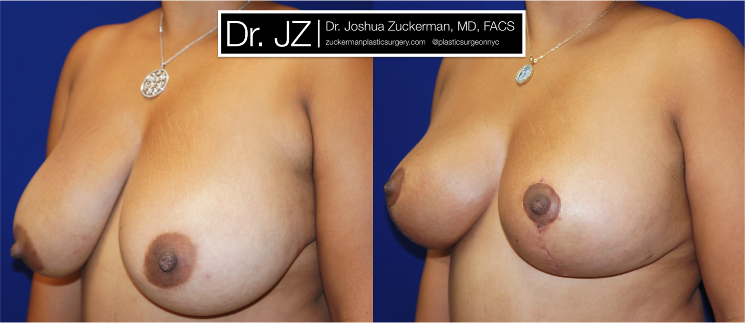Left oblique view of Breast Lift patient, female, 1 month post-op. Vertical breast lift.