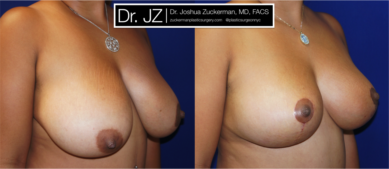 Right oblique view of Breast Lift patient, female, 1 month post-op. Vertical breast lift.