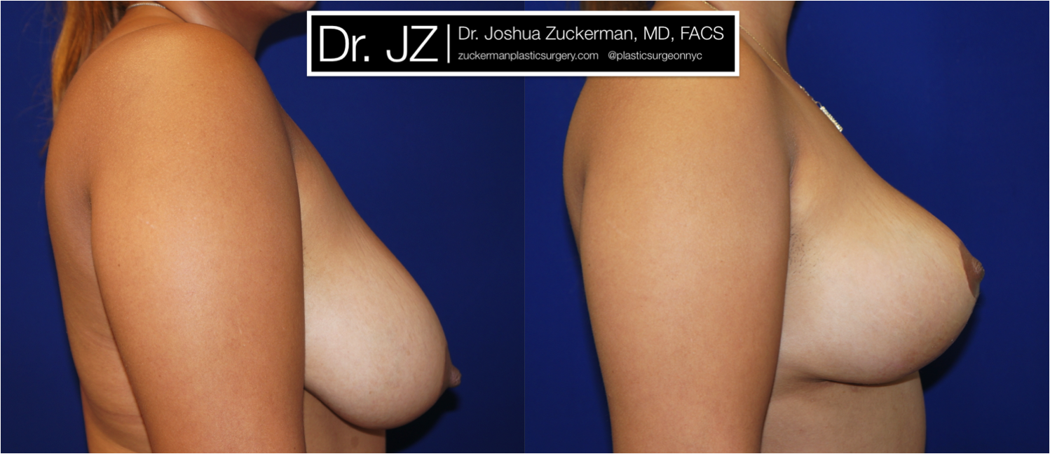 Right profile view of Breast Lift patient, female, 1 month post-op. Vertical breast lift.