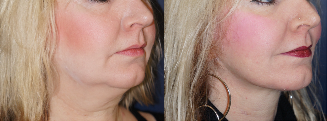 neck lift, before and after, plastic surgery, 1, left oblique