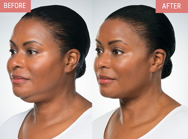 Dr. Zuckerman discusses Kybella treatment as a trend to eliminate submental, under-chin, fat to maintain a 