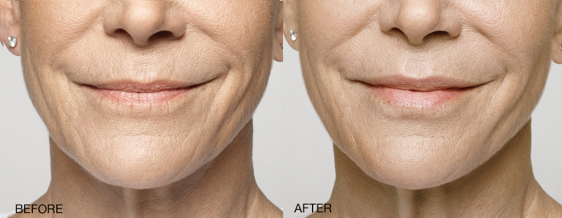 Restylane® Silk manufacturer before and after patient comparison. Patient treated with 2.8cc of Restylane Silk in the lips. 4 weeks after treatment.