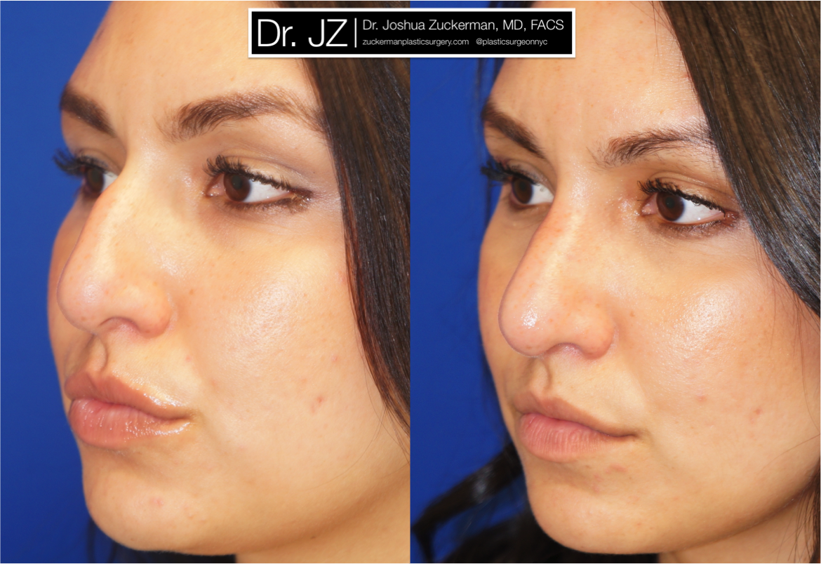 Left oblique view of Rhinoplasty patient, female, 2 months post-op. Dorsal hump reduction.