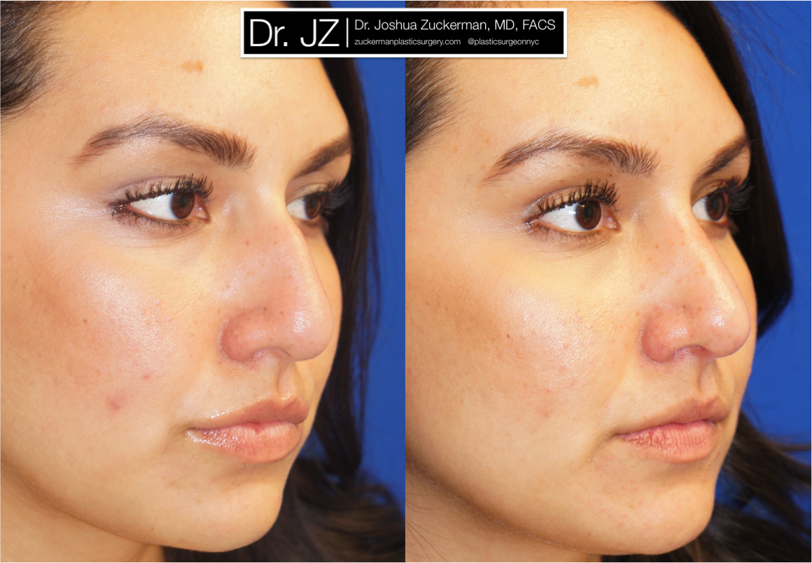 Right oblique view of Rhinoplasty patient, female, 2 months post-op. Dorsal hump reduction.
