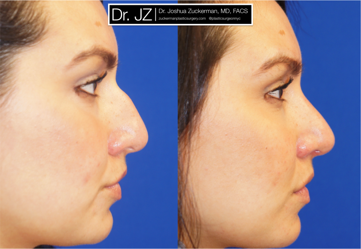 Right profile view of Rhinoplasty patient, female, 2 months post-op. Dorsal hump reduction.