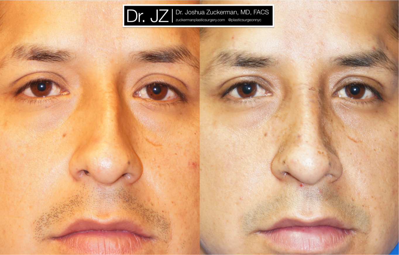 Frontal view of Rhinoplasty patient, male, 1.5 months post-op. Dorsal hump reduction, nasal bony asymmetry corrected.