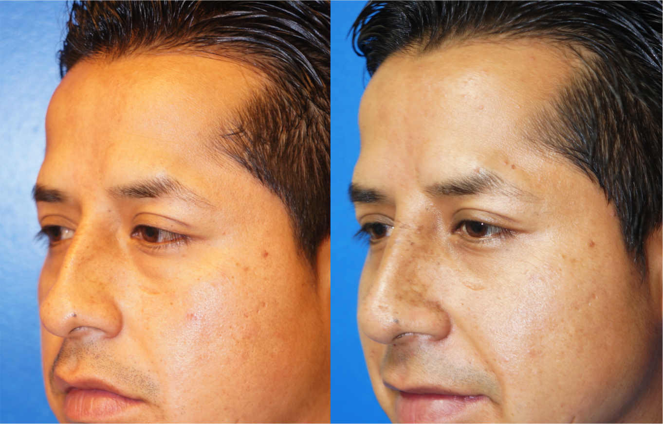 Left oblique view of Rhinoplasty patient, male, 1.5 months post-op. Dorsal hump reduction, nasal bony asymmetry corrected.