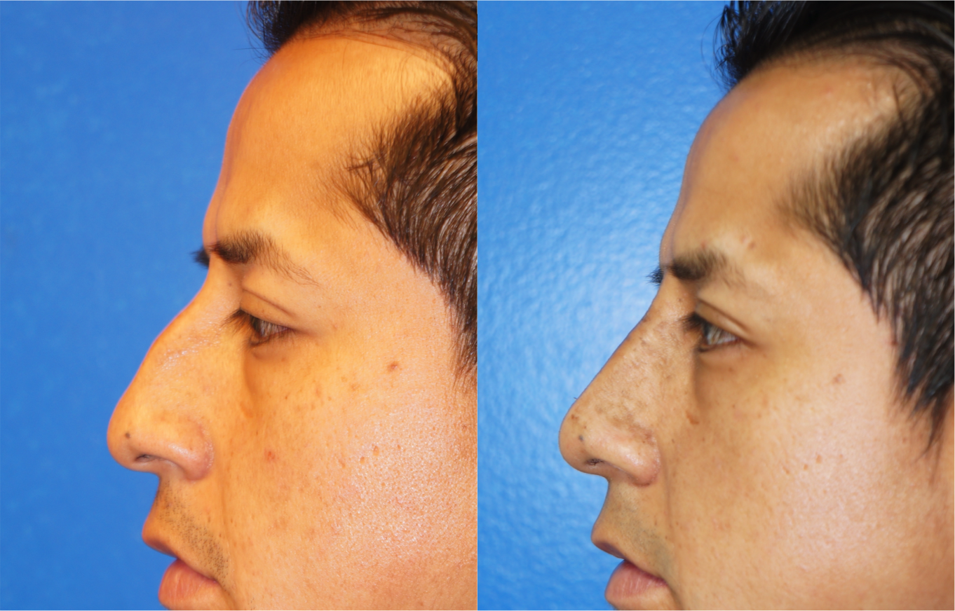 Left profile view of Rhinoplasty patient, male, 1.5 months post-op. Dorsal hump reduction, nasal bony asymmetry corrected.