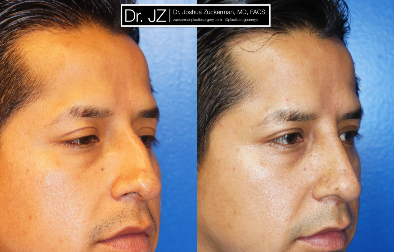 Right oblique view of Rhinoplasty patient, male, 1.5 months post-op. Dorsal hump reduction, nasal bony asymmetry corrected.