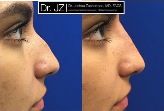 Right profile view of a non-surgical rhinoplasty patient, female. Treatment reduces the prominence of dorsal hump. Juvederm Ultra Plus injected above and below the hump. Images taken day of treatment.