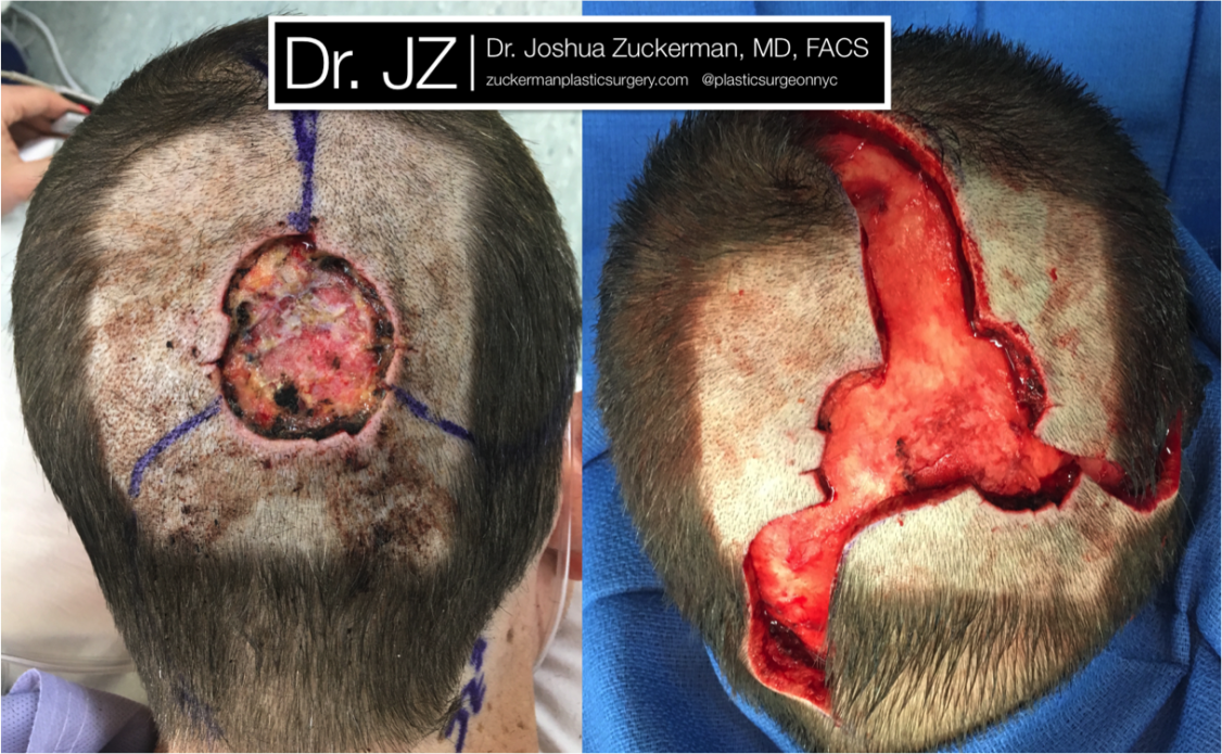 Initial stages of reconstruction of a 4.5cm scalp vertex defect after Moh's excision of basal cell carcinoma using pinwheel flaps. 1 month post-op.