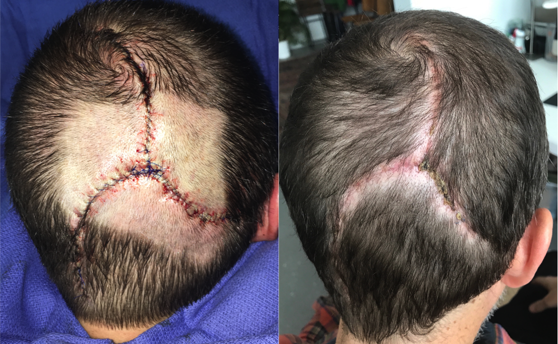 Finalizing the reconstruction of a 4.5cm scalp vertex defect after Moh's excision of basal cell carcinoma using pinwheel flaps. 1 month post-op.
