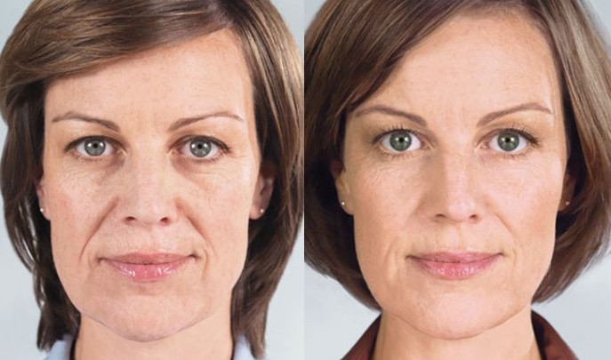 Sculptra official before and after from Galderma. Dr. Zuckerman uses this injectable in his practice in New York City.