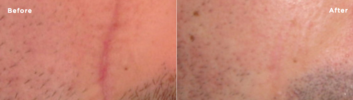 Before and after comparison of the reduction in redness of a previous scar using SkinMedica's Scar Recovery Gel.