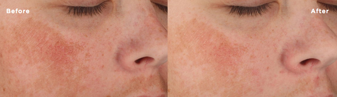 Before and after comparison of Lytera application twice daily for twelve weeks.