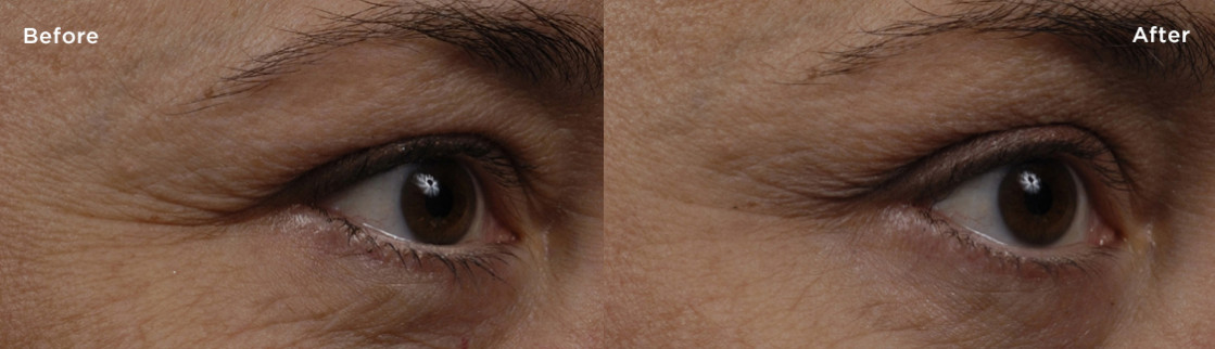 Before and after comparison of crow's feet around the eyes using SkinMedica's TNS Essential Serum containing 93%+ growth factors.