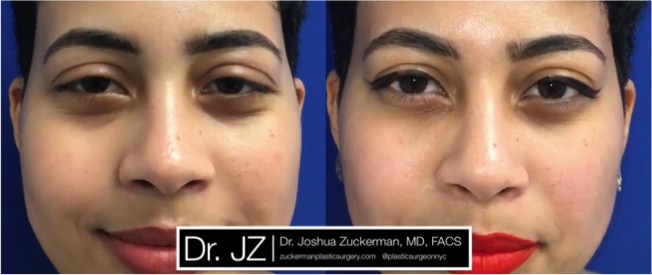 Restylane Injections Treatment NYC – Top Ranked Zuckerman Plastic Surgery