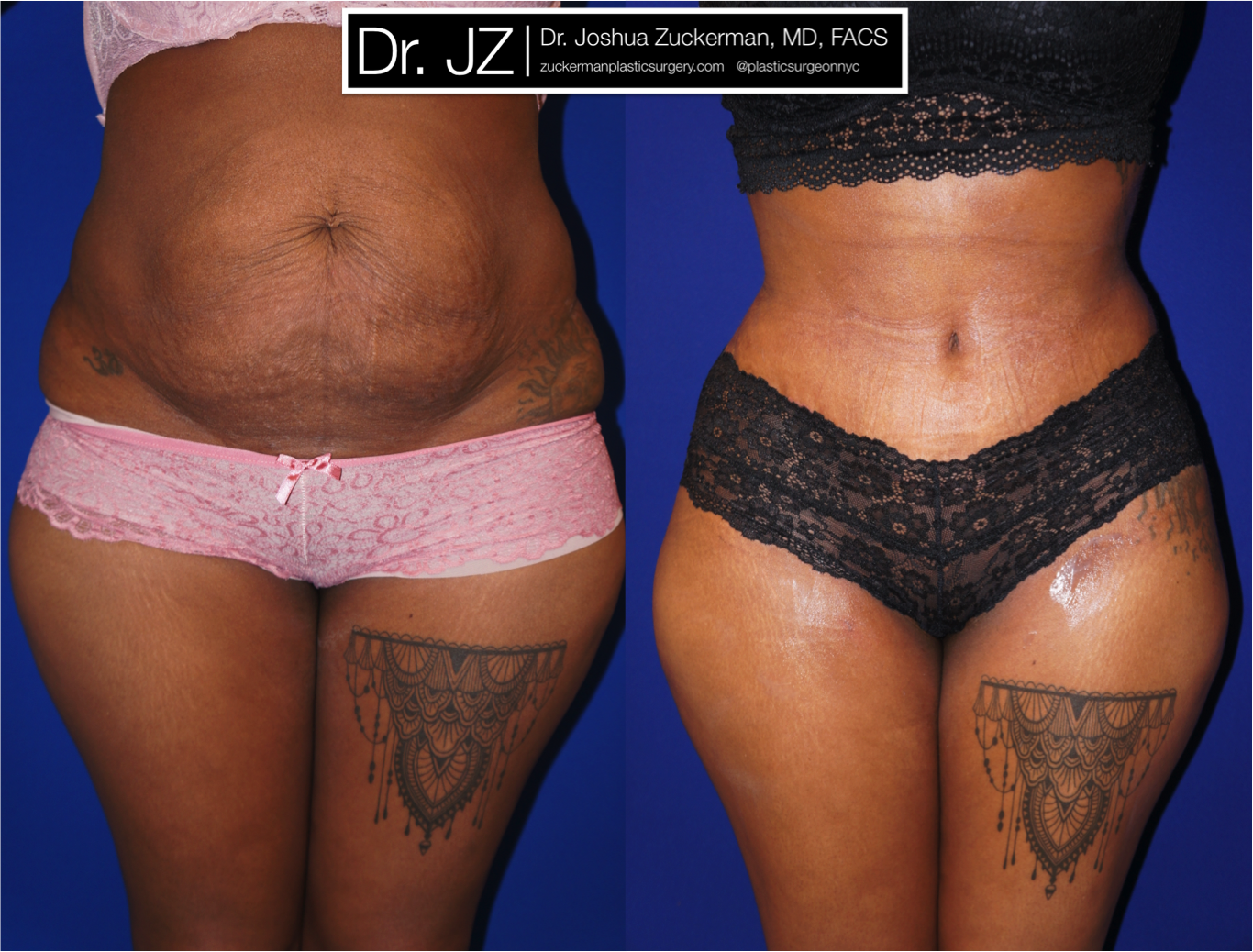 Frontal view of Abdominoplasty patient, female, 1 month post-op. Liposuction of the abdomen and flanks performed as well.