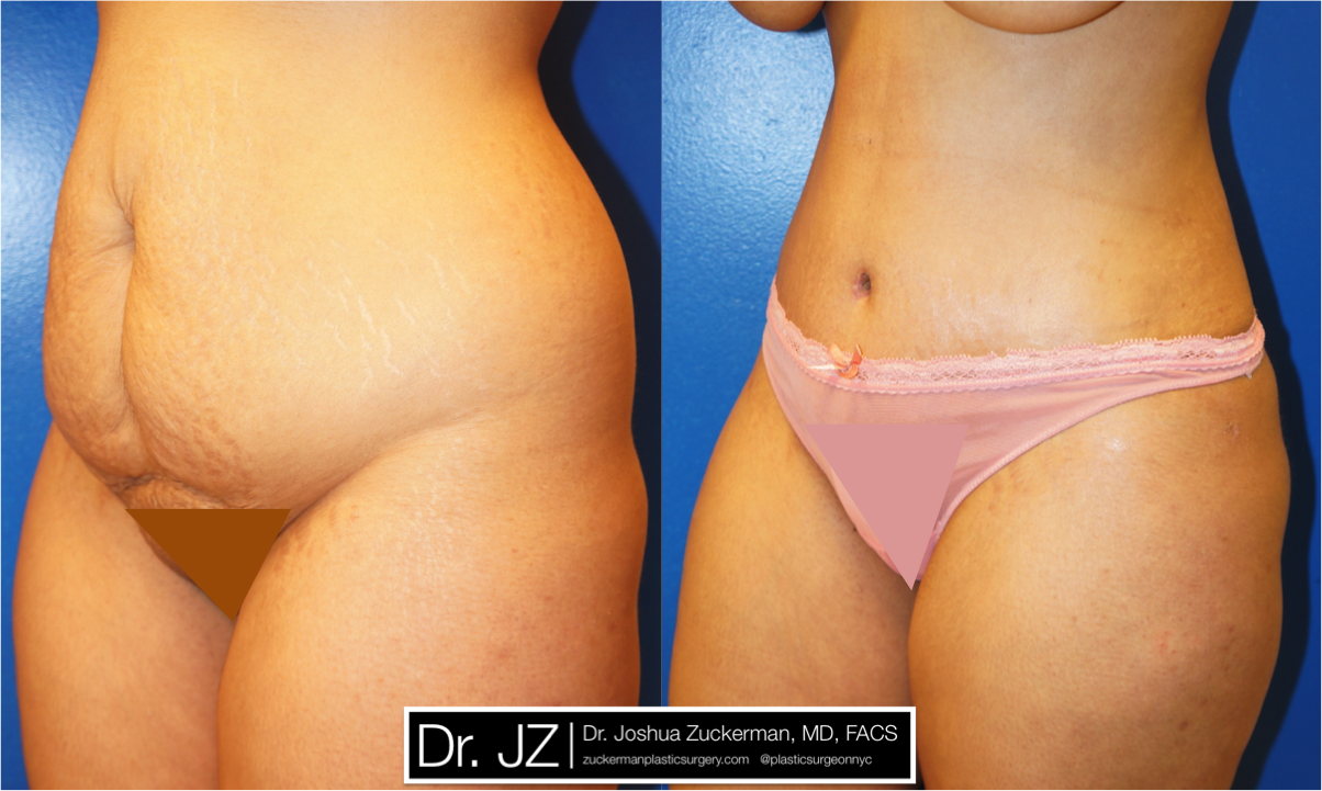 Left oblique view of Abdominoplasty patient by Dr. Zuckerman, female, 1 month post-op.