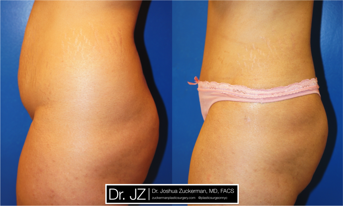 Left profile view of Abdominoplasty patient, female, 1 month post-op.
