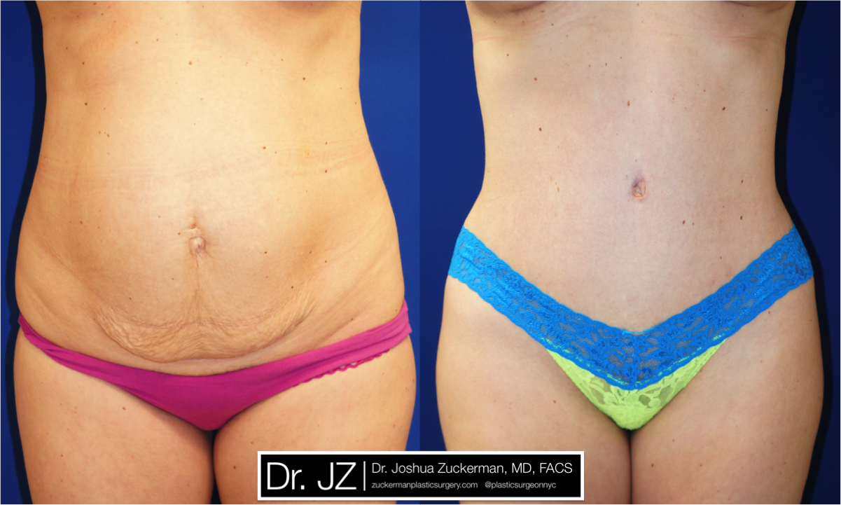 Frontal view of Abdominoplasty patient, female, 1 month post-op. 1 Liter of fat removed via liposuction of the abdomen and flanks as well.