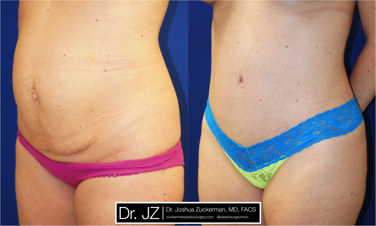 Left oblique view of Abdominoplasty patient, female, 1 month post-op. 1 Liter of fat removed via liposuction of the abdomen and flanks as well.