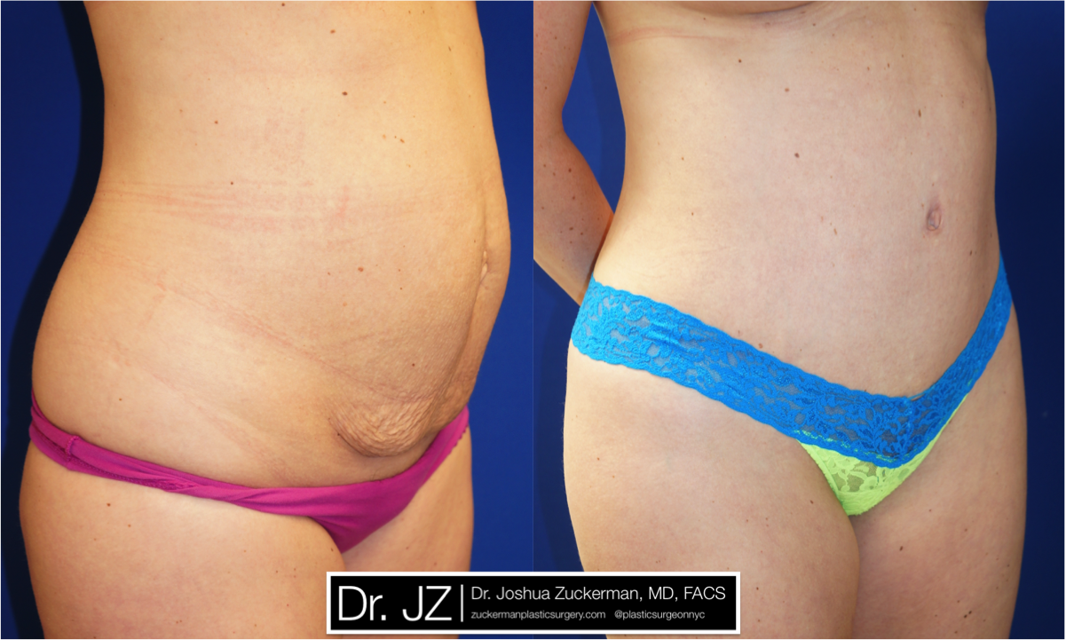 Right oblique view of Abdominoplasty patient, female, 1 month post-op. 1 Liter of fat removed via liposuction of the abdomen and flanks as well.