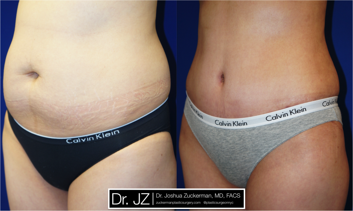 Left oblique view of Abdominoplasty patient, female, 2 months post-op. Liposuction of the abdomen and flanks performed as well.