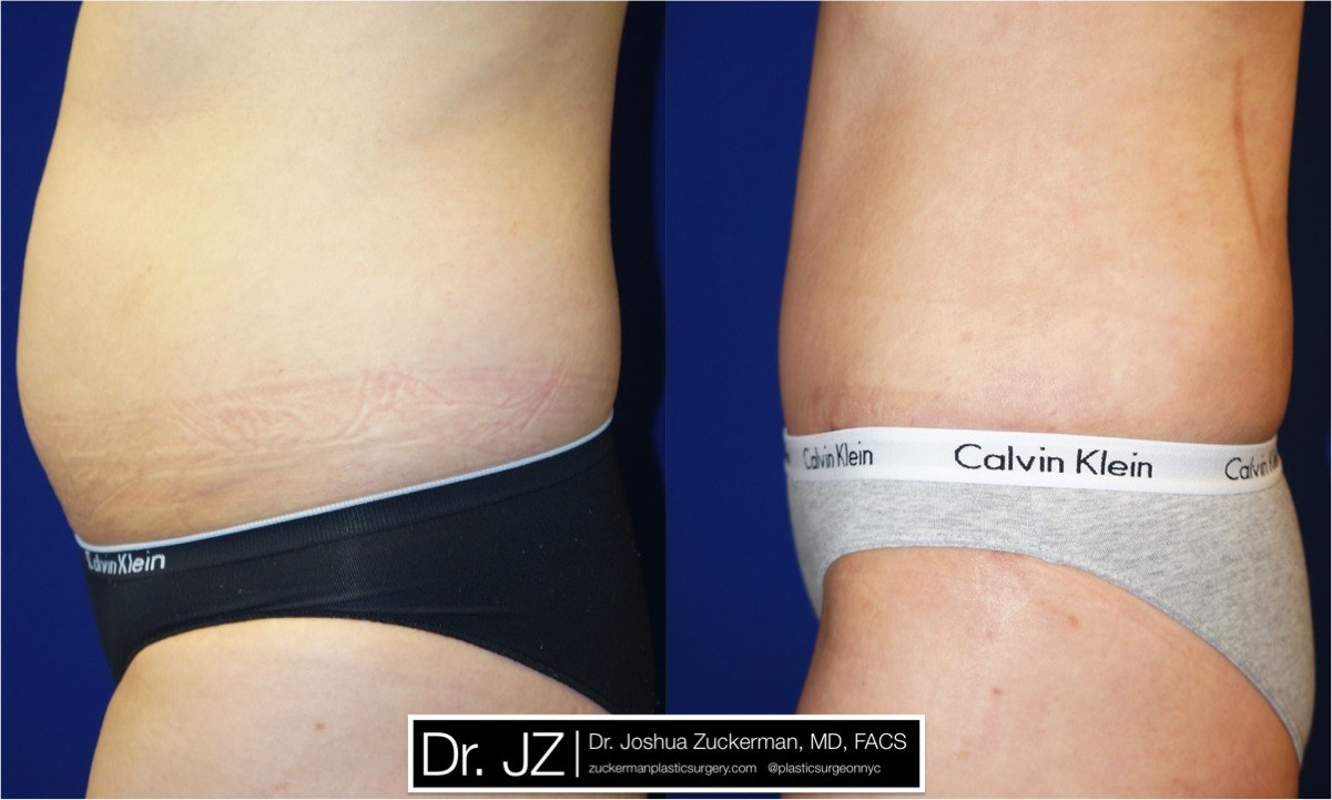 Left profile view of Abdominoplasty patient, female, 2 months post-op. Liposuction of the abdomen and flanks performed as well.