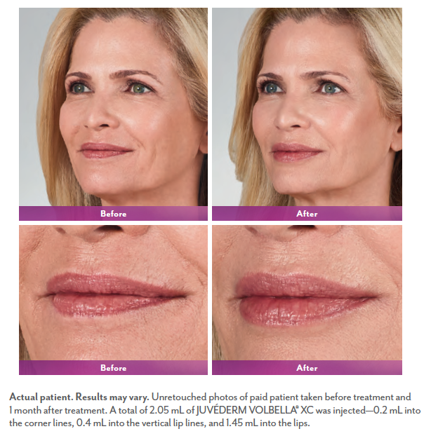 Volbella treatment for vertical lines around the lips and lip augmentation before and after. Source: official before&after photo from manufacturer Allergan.