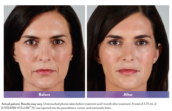 Vollure treatment for nasolabial folds. Source: official before&after photo from manufacturer Allergan.
