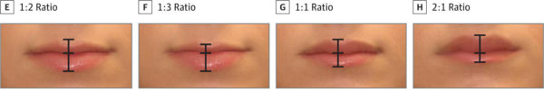 Image courtesy of The JAMA Network. Copyright 2017 by the American Medical Association. An image from a medical study in the journal of JAMA Facial Plastic Surgery examining what the most aesthetically pleasing ratio of upper to lower lip is for women.