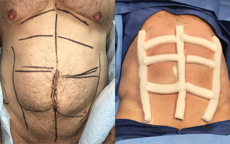 Dr. Zuckerman performs targeted liposuction to the abdomen, also known as abdominal etching, to improve the aesthetic appearance of the abdominal muscles. This cosmetic surgery is most commonly performed for men.