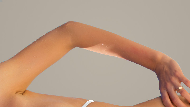Dr. Zuckerman performs arm lift surgery, or brachioplasty, to improve the aesthetic appearance of the arms and remove excess skin after weight loss or due to aging.