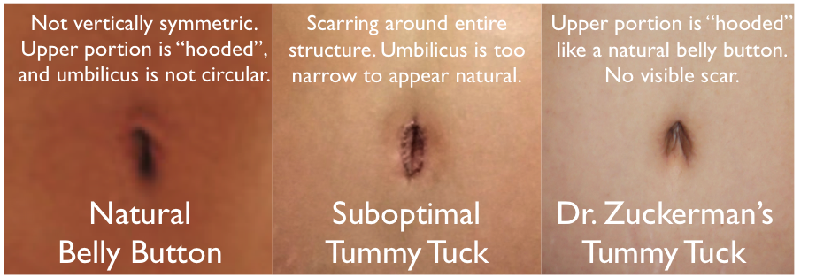 Dr. Zuckerman compares a natural belly button with a suboptimal tummy tuck and against his own technique. The belly button Dr. Zuckerman creates has no visible scar, is "hooded" like a natural belly button, and is similar in shape.