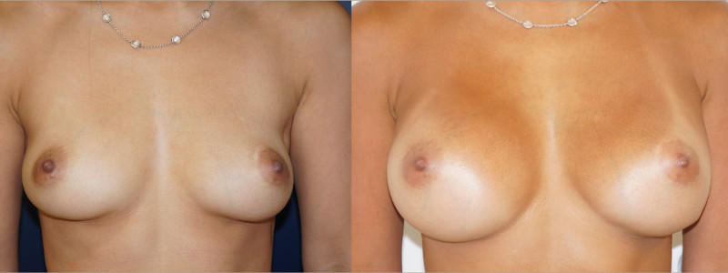 Frontal view of a breast augmentation outcome by Dr. Zuckerman.
