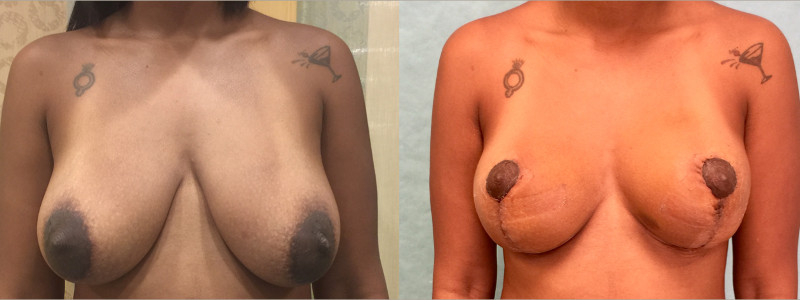 Frontal view of a breast lift (mastopexy) outcome by Dr. Zuckerman.