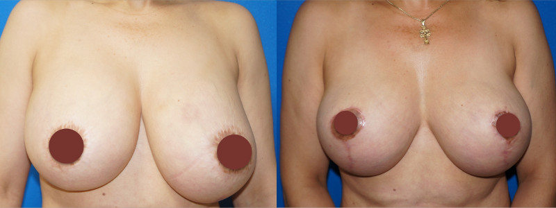 Frontal view of a breast revision and breast lift outcome by Dr. Zuckerman.