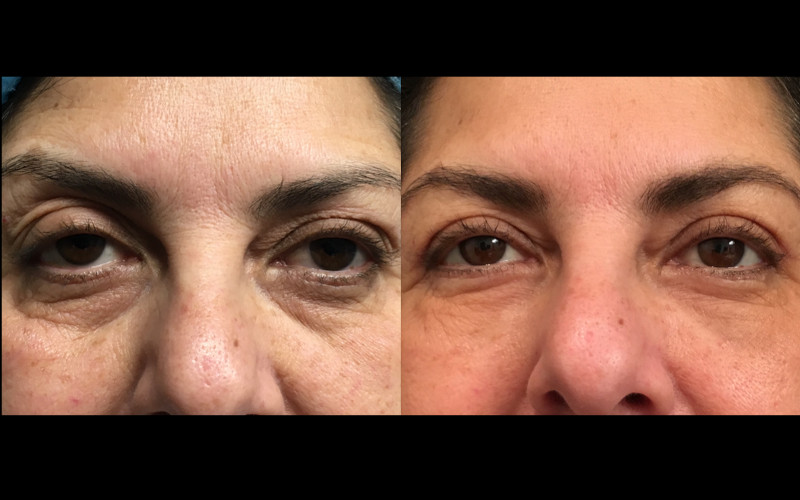 Dr. Zuckerman can correct wrinkles and a hollowed out or tired appearance around the eye with cosmetic eyelid surgery, or blepharoplasty.`