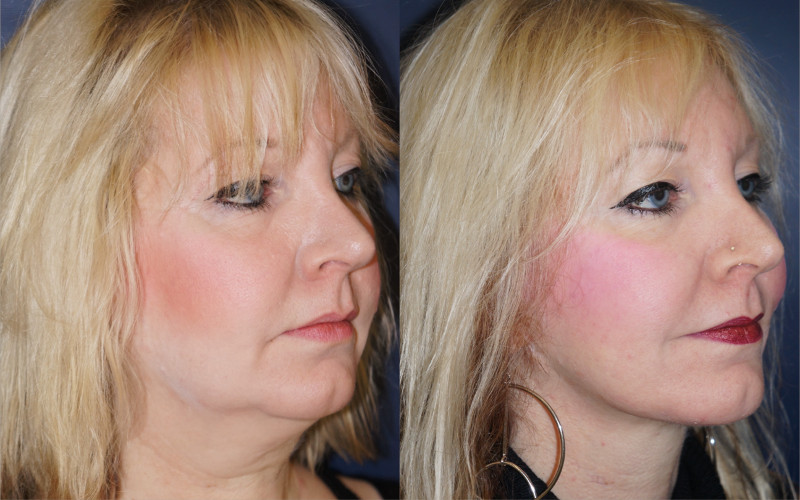 facelift, before and after, plastic surgery, 1, left oblique