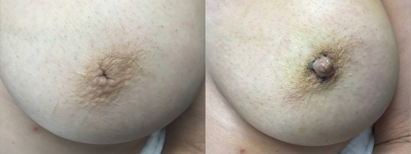 Inverted Nipple Surgery outcome by Dr. Zuckerman.
