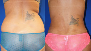 Posterior view of one of Dr. Zuckerman's liposuction outcomes.