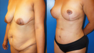 Right oblique view of one of Dr. Zuckerman's Mommy Makeover outcomes.