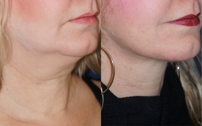 A neck lift by Dr. Zuckerman can eliminate deposits of fat due to weight gain or again and address jowling along the jaw line.