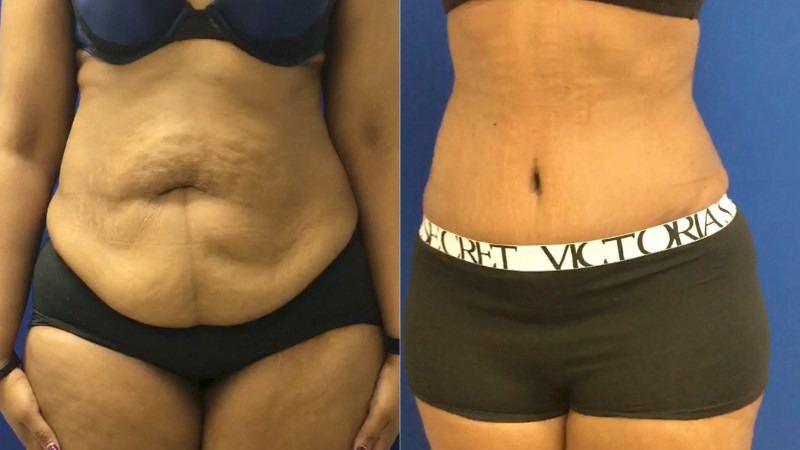 Post weight loss surgery patient outcome by Dr. Zuckerman. Patient underwent a tummy tuck (abdominoplasty) to remove large amounts of excess hanging skin.