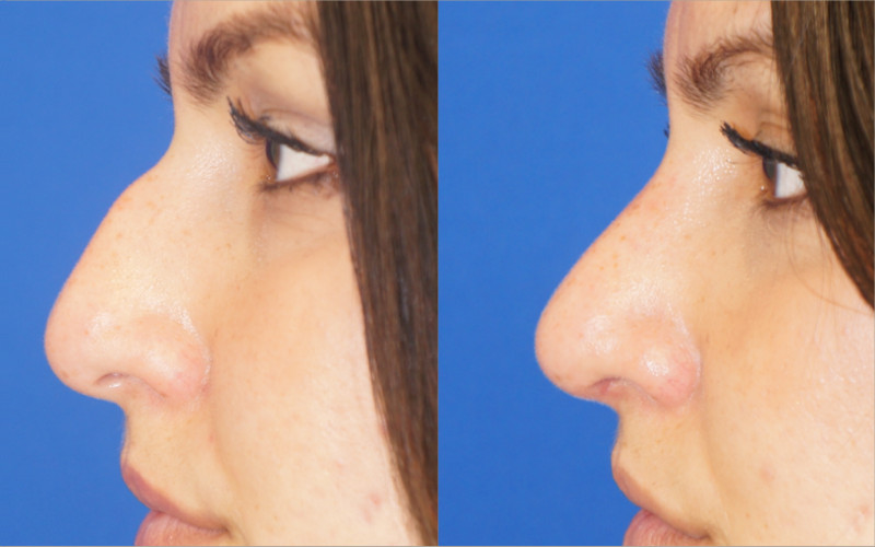 Rhinoplasty, or nose surgery, by Dr. Zuckerman can address a variety of aesthetic concerns about one's nose. These include a dorsal hump, nasal asymmetry, nasal tip aesthetic issues, and more.