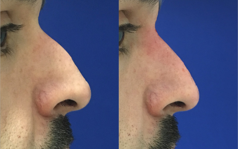 Dr. Zuckerman offers an array of non-surgical and minimally invasive treatments for men including non-surgical rhinoplasty, Botox injections, lip augmentation, laser resurfacing and more.