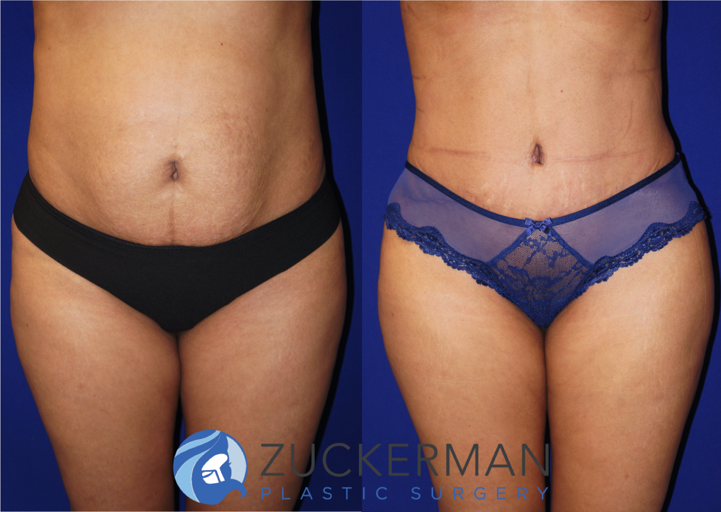 Frontal view of an abdominoplasty (tummy tuck) by Dr. Zuckerman, images taken before surgery and two months after. Includes liposuction to the abdomen and flanks.