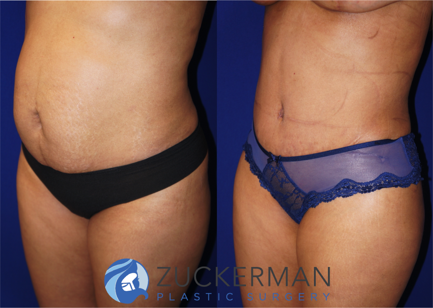 Left oblique view of an abdominoplasty (tummy tuck) by Dr. Zuckerman, images taken before surgery and two months after. Includes liposuction to the abdomen and flanks.