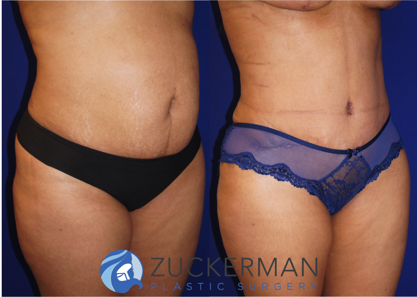 Right oblique view of an abdominoplasty (tummy tuck) by Dr. Zuckerman, images taken before surgery and two months after. Includes liposuction to the abdomen and flanks.